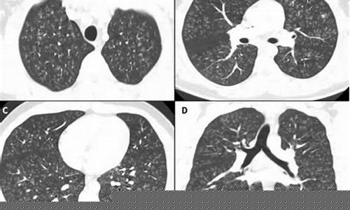 电子烟肺状态(电子烟肺结节)