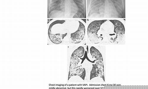 电子烟肺炎的治疗方法与康复指南